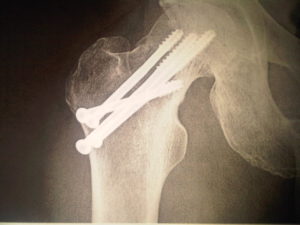 Broken hip repaired with screws